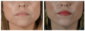 Before_After_Filler_To_Jawline5 Before After Filler To Jawline5 300x111 Before & After