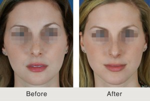 ChinImplant-Rhinoplasty1-large ChinImplant Rhinoplasty1 large 300x203 Before & After