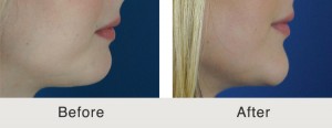 ChinImplant Rhinoplasty5 large 300x116 Chin Implants
