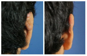 Excision_Keyloid_Ear_2 Excision Keyloid Ear 2 Before & After