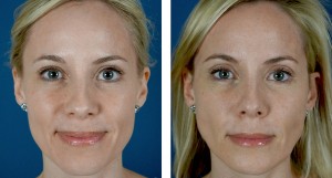 Kulbersh-Filler-eyelid-charlotte Kulbersh Filler 1 30 13 6 300x161 Before & After