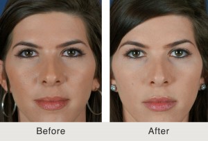Kulbersh-NonSurgicalBrowlift Kulbersh NonSurgicalBrowlift4 large 300x203 Before & After