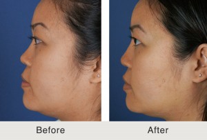 Kulbersh NonSurgicalRhinoplasty1 large 300x203 Rhinoplasty