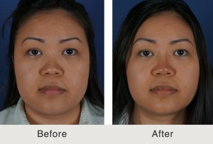 Kulbersh-NonSurgicalRhinoplasty Kulbersh NonSurgicalRhinoplasty3 large 300x203 Before & After