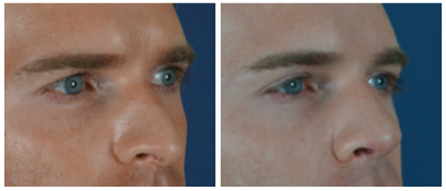 Rhinoplasty Fillers before after Rhinoplasty