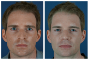 Before_After_Male_Rhinoplasty Screen shot 2012 12 18 at 10.49.10 PM 300x203 Before & After