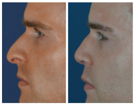 before after rhinoplasty and fillers1 Rhinoplasty