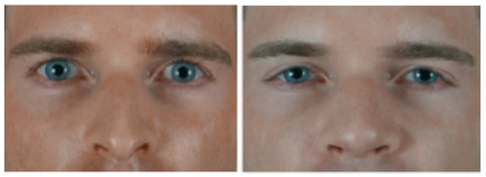 frontal view fillers rhinoplasty1 Rhinoplasty