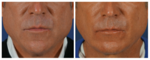 liquid-necklift-charlotte-3 liquid necklift charlotte 3 300x120 Before & After