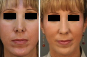 revision-rhinoplasty-before-after-300x1981 revision rhinoplasty before after 300x19811 Before & After