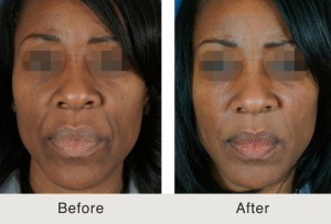 AfricanAmerican Cheek SmileLine Fillers1 large 300x203 Facial Fillers