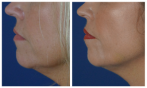 Before After Filler To Jawline1 300x180 Facial Fillers