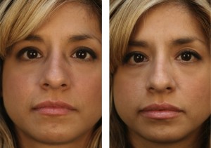 Lip_Injection Lip Augmentation