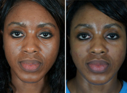 facial filler before after1 Facial Fillers