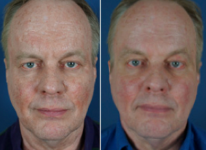 sculptra male 300x218 Facial Fillers