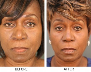 African-American-Rhinoplasty-Front African American Rhinoplasty Front 300x237 Before & After