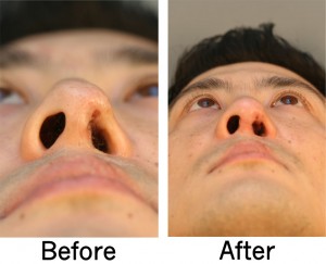 Cleft lip Rhinoplasty Below Face 300x243 Cleft Rhinoplasty