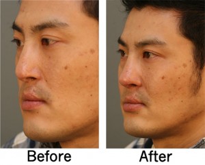 Cleft lip Rhinoplasty Left Angle 300x241 Cleft Rhinoplasty