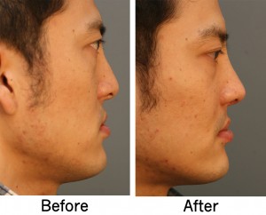 Cleft lip Rhinoplasty Right Side 300x242 Cleft Rhinoplasty