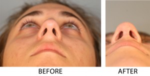 External_Rhino_Below_Face External Rhino Below Face 300x152 External Rhinoplasty