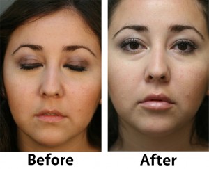 Lip_Augmentation_1 Lip Augmentation 1 300x243 Before & After