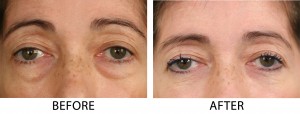 Lower blepharoplasty fat repostioning cropped 300x114 Blepharoplasty