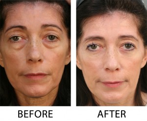 Lower blepharoplasty with fat repostioning full face 300x247 Blepharoplasty