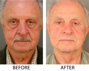 Neck_Lift_Front Neck Lift Front 300x239 Before & After
