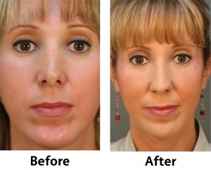 Revision_Rhinoplasty_Front Revision Rhinoplasty Front 300x241 Revision Rhinoplasty