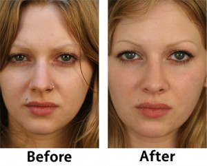 Rhinoplasty_1_Front Rhinoplasty 1 Front 300x241 Before & After