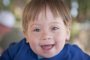 downs downs 300x199 Ethical Dilemma, Plastic Surgery on Patients with Disabilities