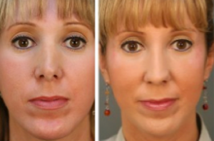 revision rhinoplasty before after1 300x198 What Are The Indications To Break The Bones During A Rhinoplasty?