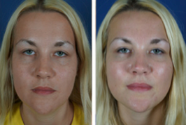 girl facial filler before after1 Getting Ahead Of The Aging Process