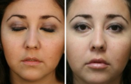 lip augmentation before after Is Video Chatting Leading To More Facial Plastic Surgery? 