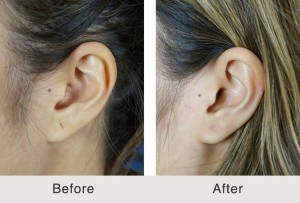  Earlobe Repair