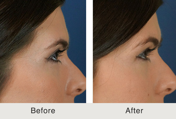 Before & After NonSurgical Browlift Carolina Facial