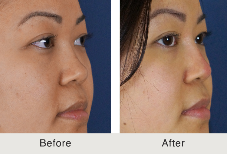 Sinus ache with bloodless signs and symptoms sinus ache behind eye no congestion