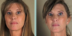 Beforeafterbotoxfacialsynkinesis 300x152 Using Botox To Treat Facial Synkinesis