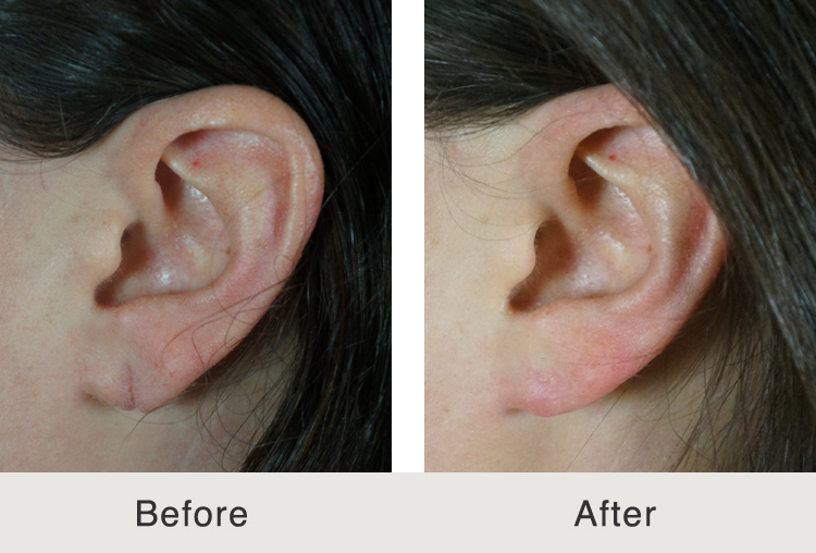 Before and After Earlobe Repair « Carolina Facial Plastic Surgery